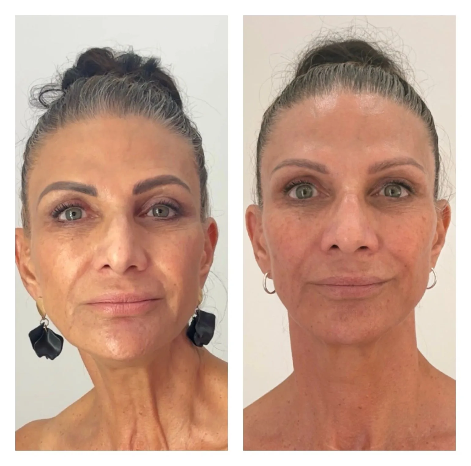 Skin Boosters — before & after