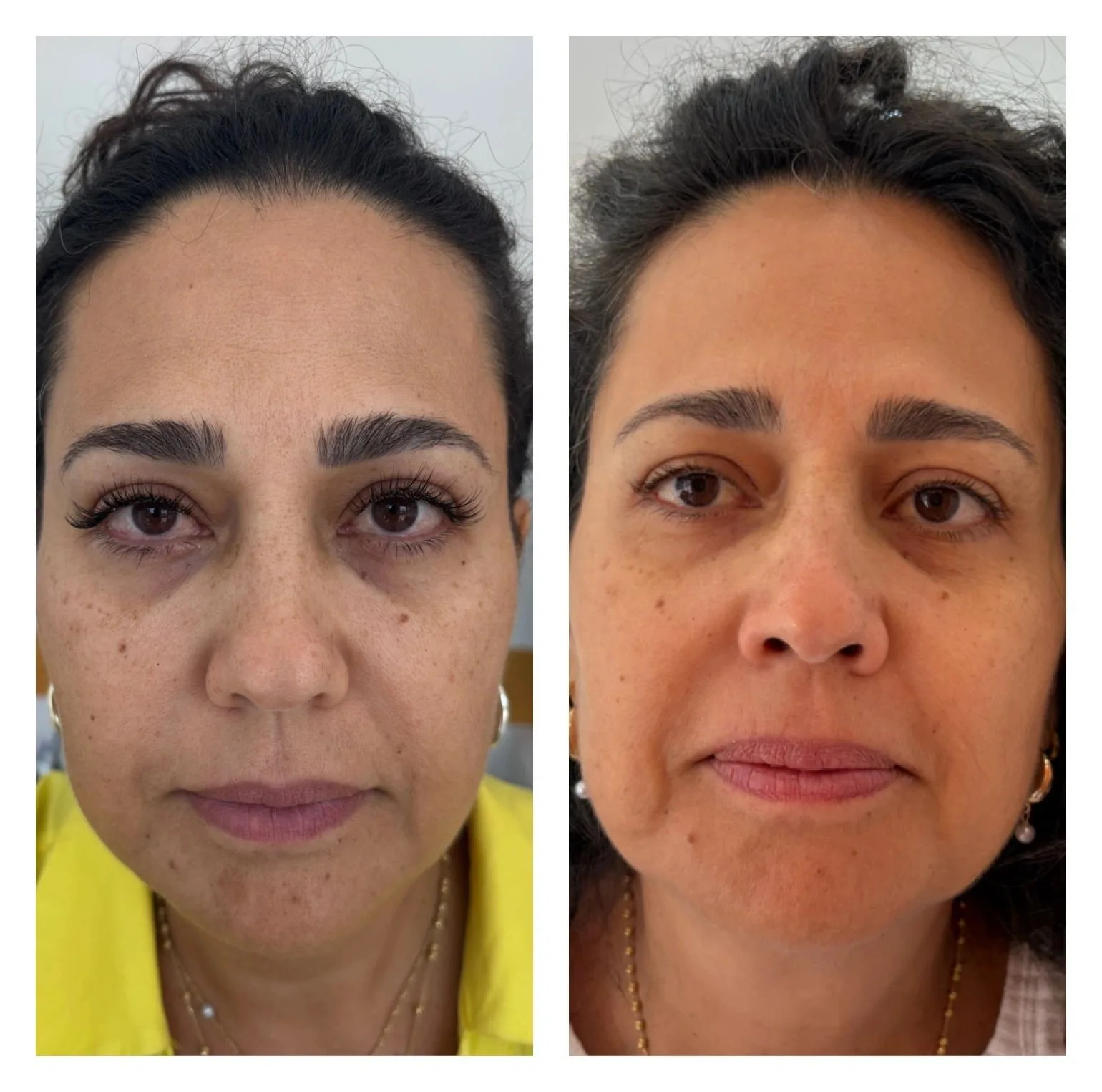 Skin Boosters — before & after