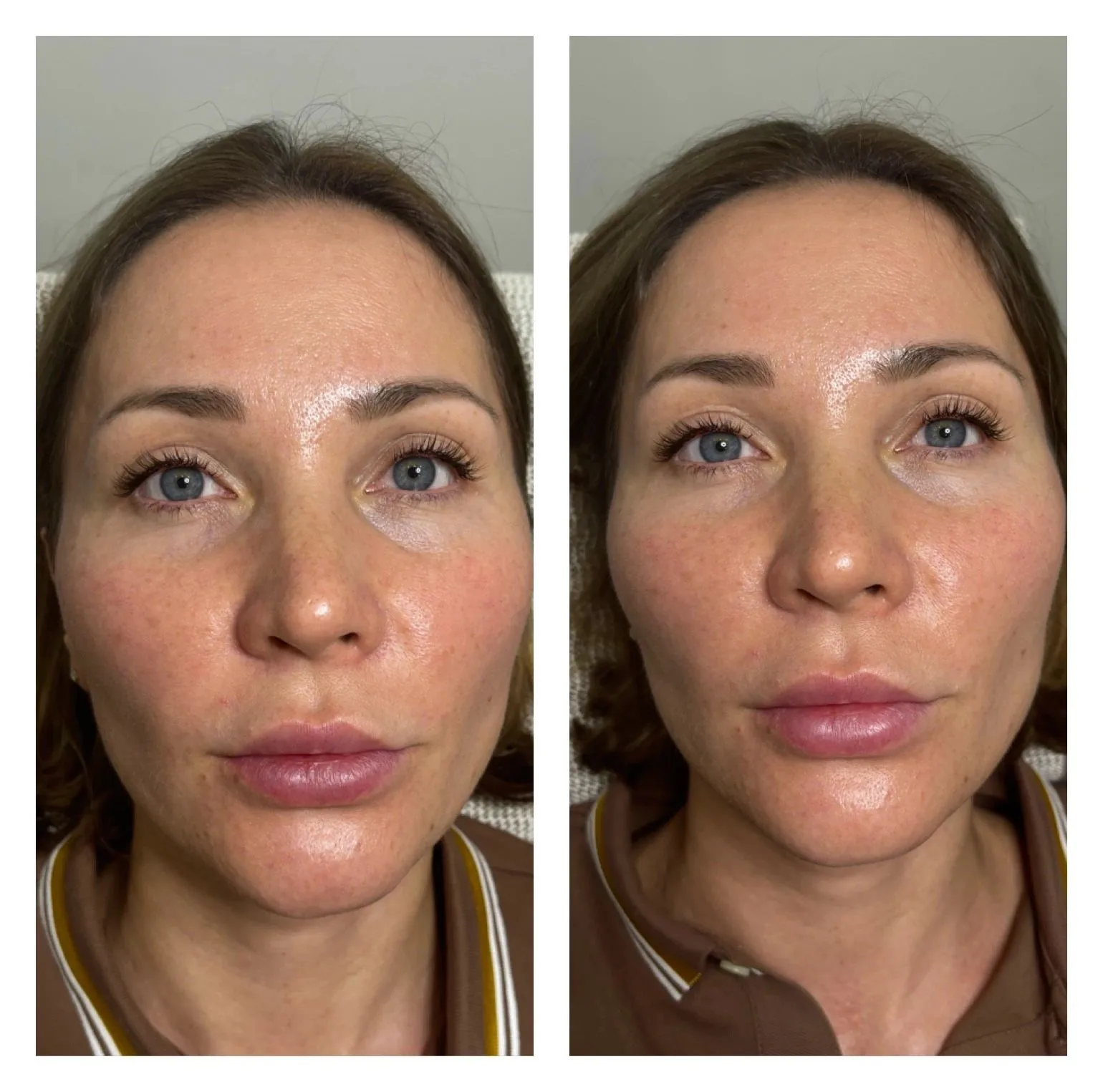 Skin Boosters — before & after