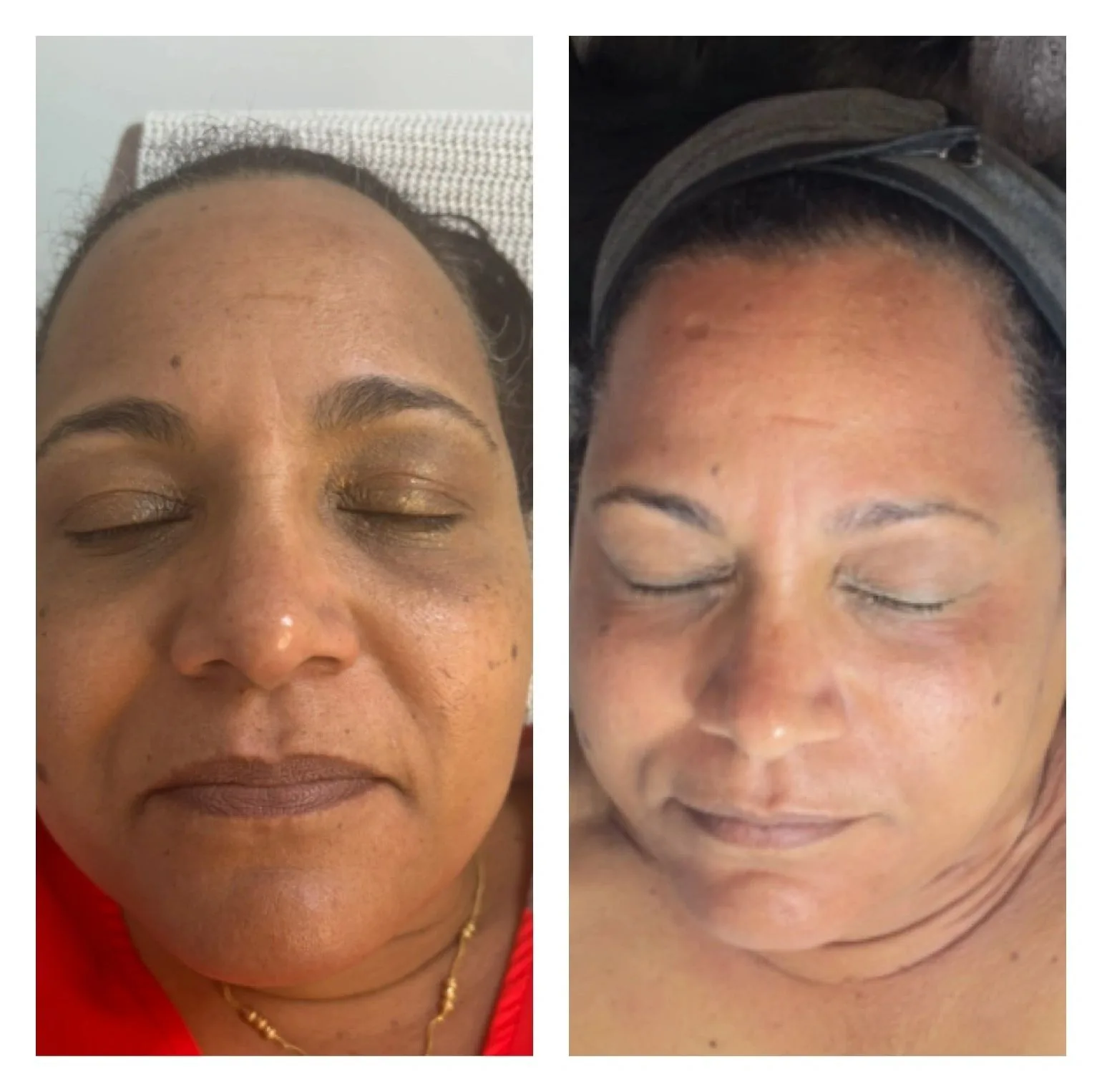 Dermapen Micro-Needling — before & after
