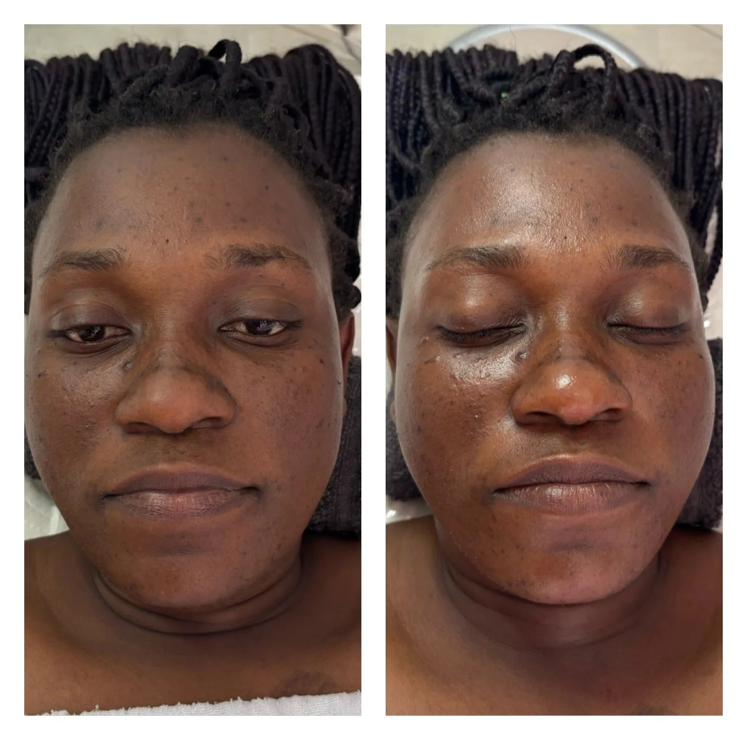 Dermapen Micro-Needling — before & after