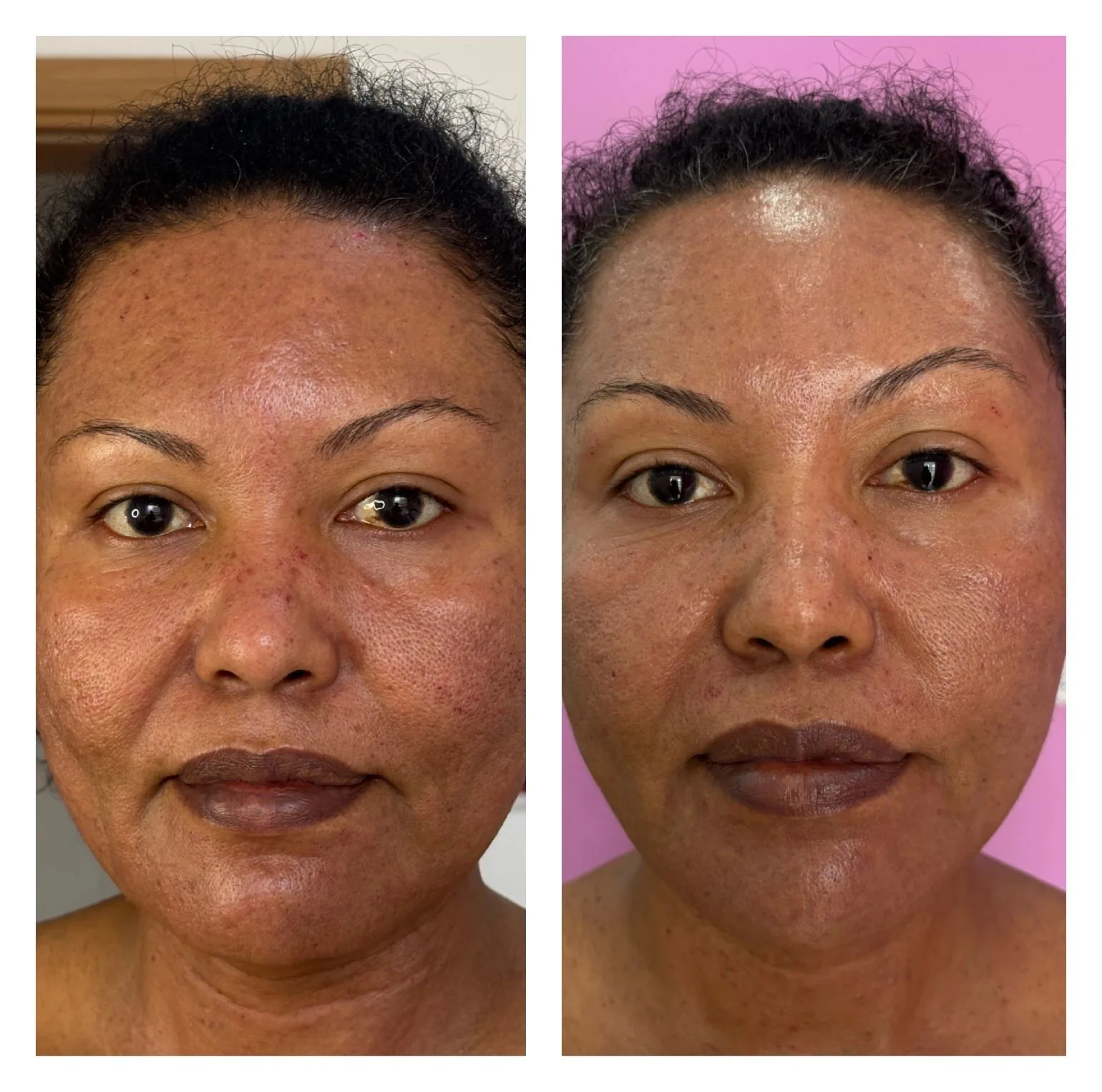 Dermapen Micro-Needling — before & after