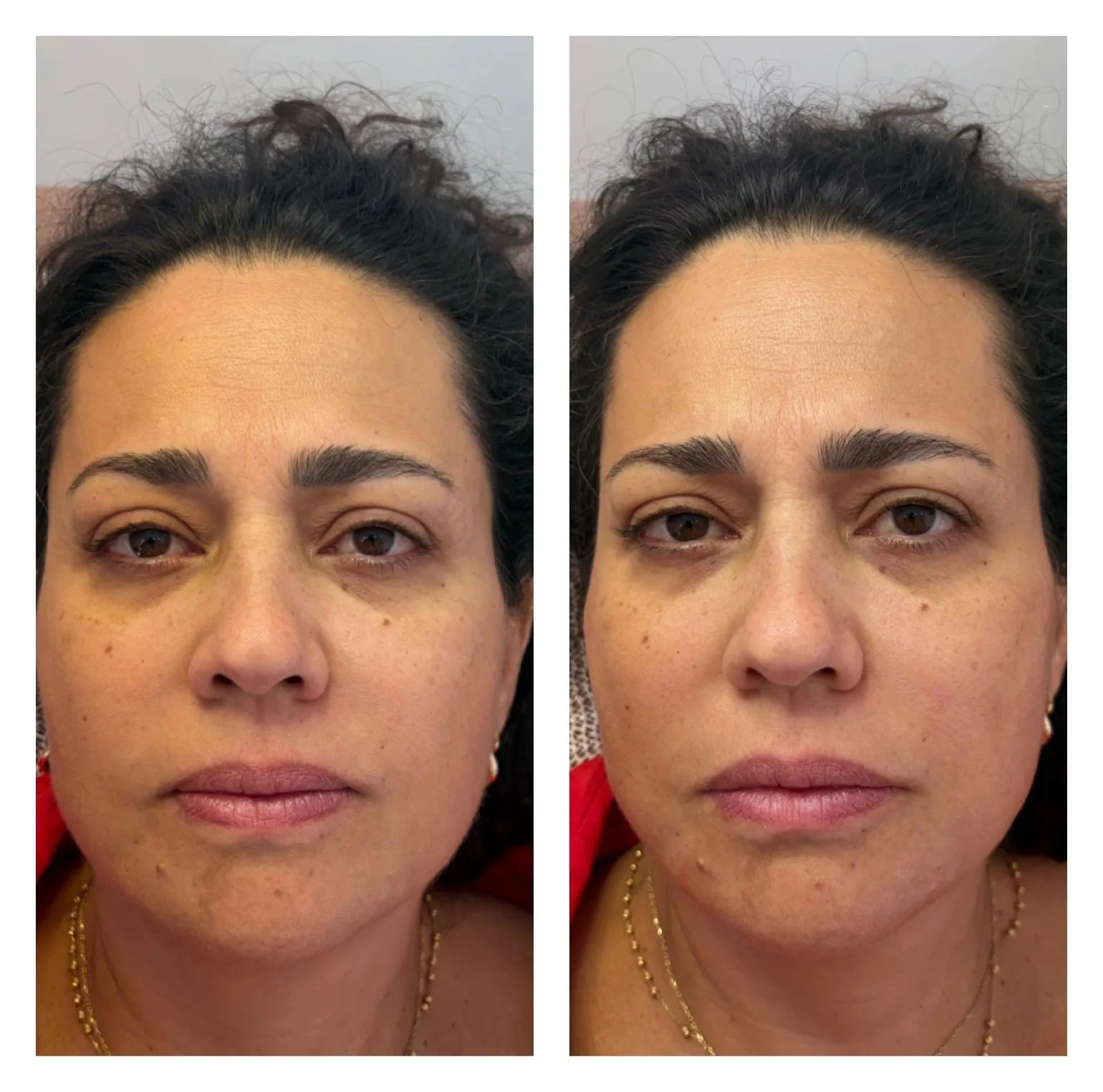 Dermapen Micro-Needling — before & after