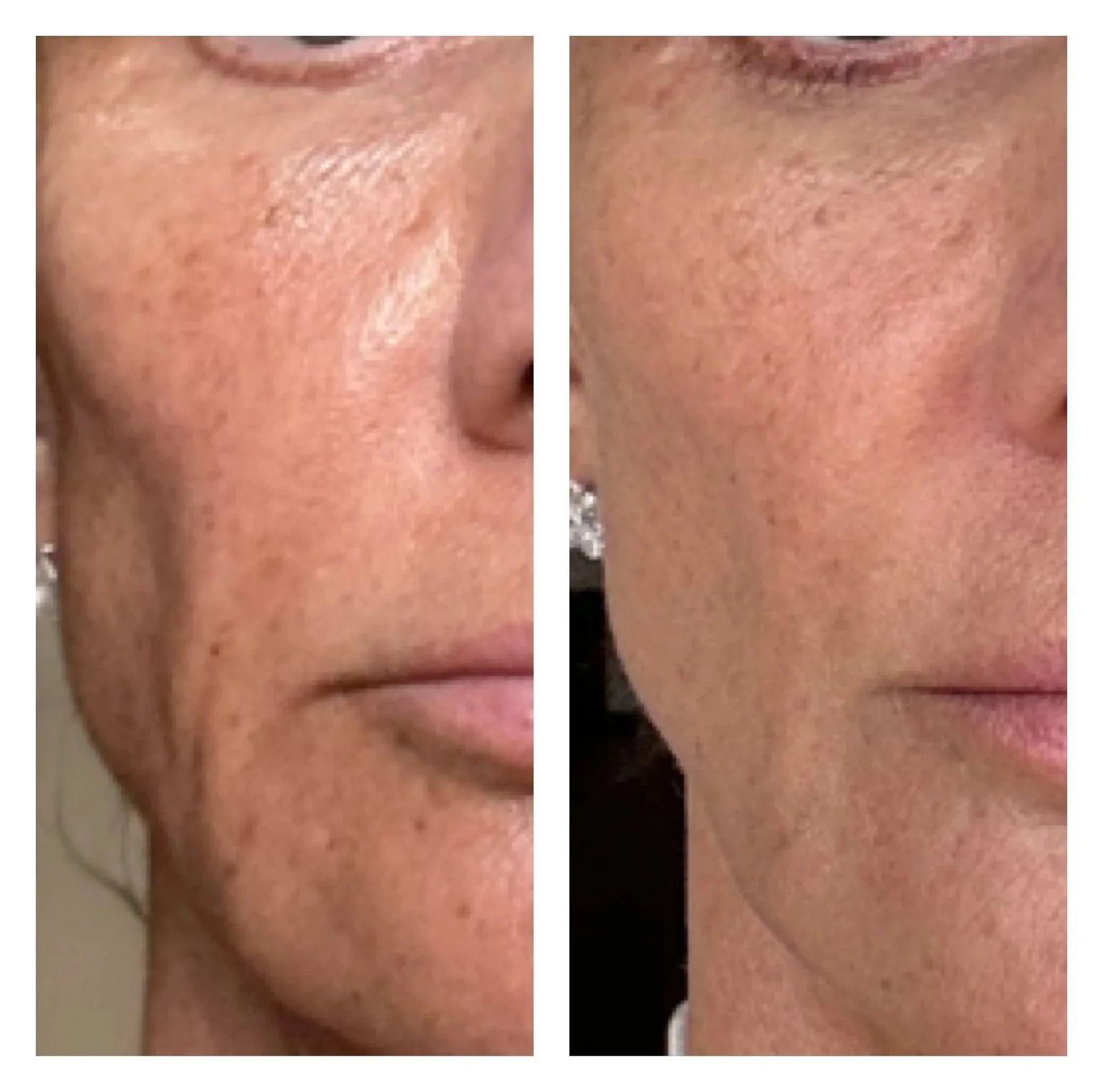 Chemical Peel — before & after